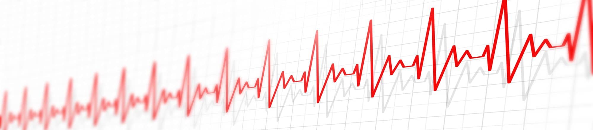 גרף מתוך בדיקת קצב לב שהתבצעה בקרדיוטים המצביע על טכיקרדיה - הפרעה בקצב הלב של המטופל